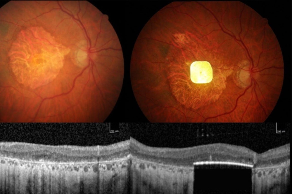 ایمپلنتی که بینایی چشم را بازمی گرداند