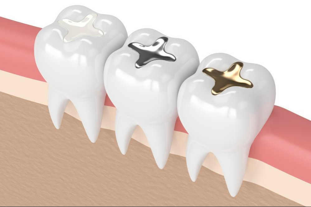 پرکردن دندان با جیوه منسوخ می شود